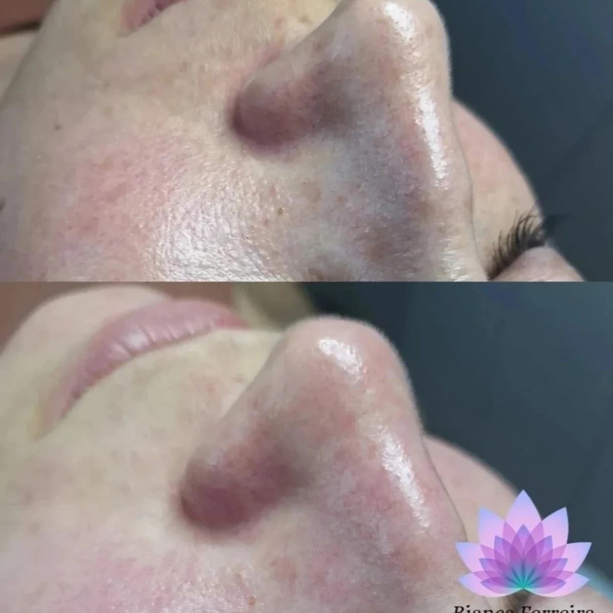 Antes e depois de limpeza de pele no nariz