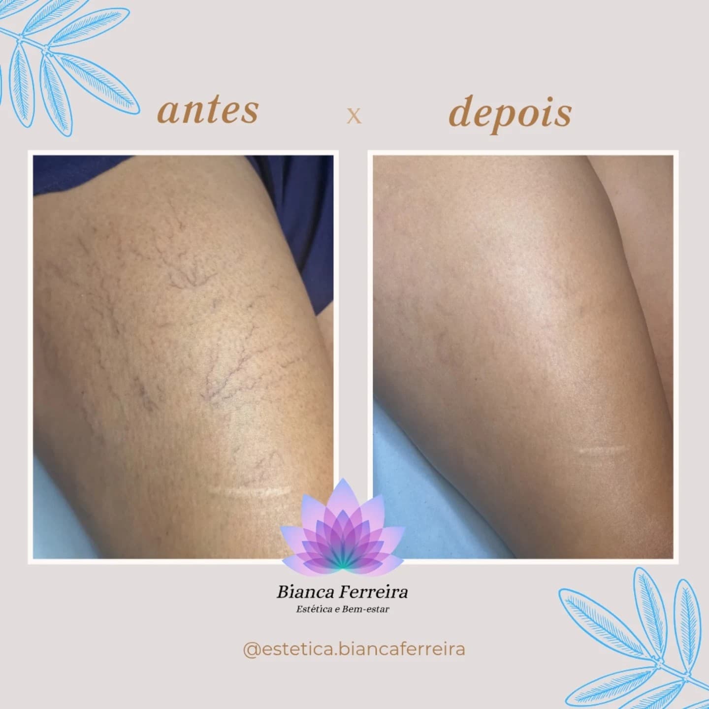 Antes e depois de secagem de vasinhos na coxa