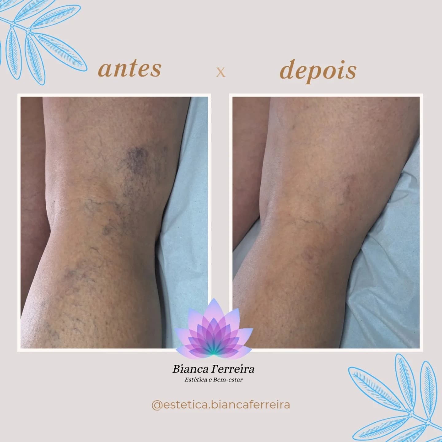 Antes e depois de secagem de vasinhos na perna